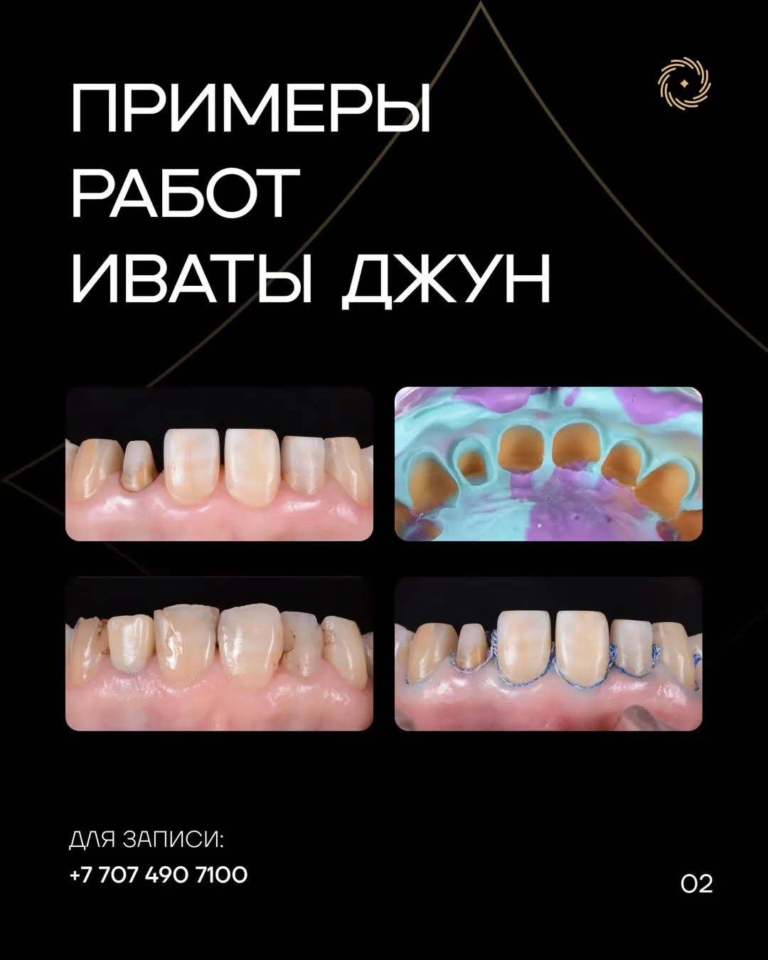 ИСКУССТВО ПРЕПАРИРОВАНИЯ ЗУБОВ ПОД ВИНИРЫ