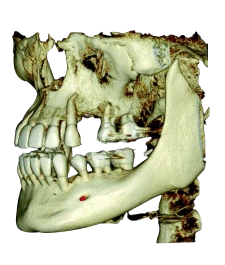 имплантация 1.jpg