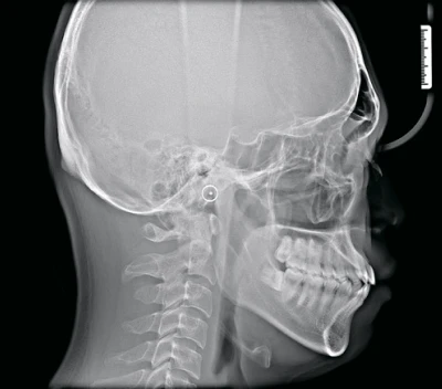 цефалостат 2.jpg